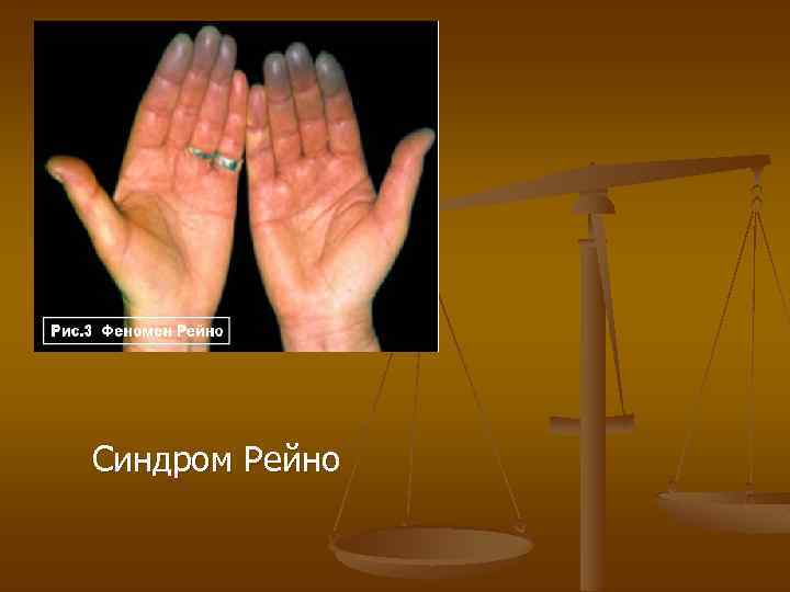 Синдром Рейно 