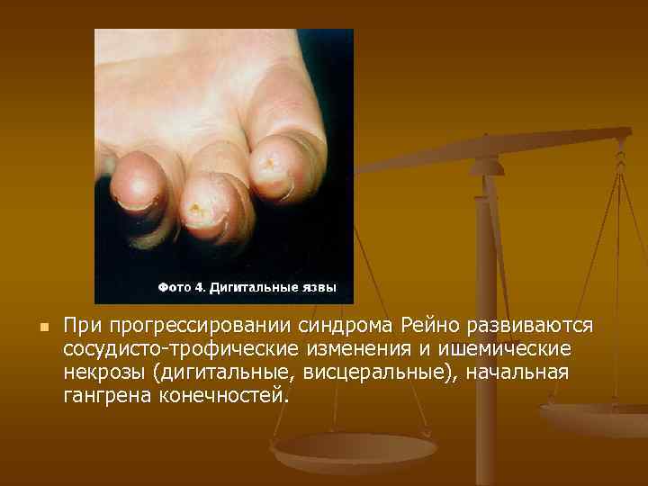 n При прогрессировании синдрома Рейно развиваются сосудисто-трофические изменения и ишемические некрозы (дигитальные, висцеральные), начальная