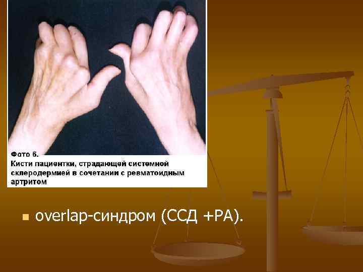 n overlap-синдром (ССД +РА). 