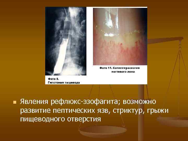 n Явления рефлюкс-эзофагита; возможно развитие пептических язв, стриктур, грыжи пищеводного отверстия 