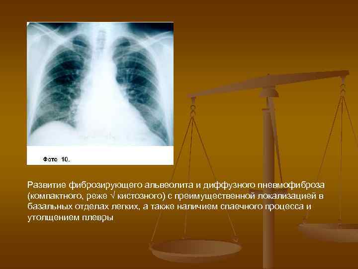 Развитие фиброзирующего альвеолита и диффузного пневмофиброза (компактного, реже √ кистозного) с преимущественной локализацией в