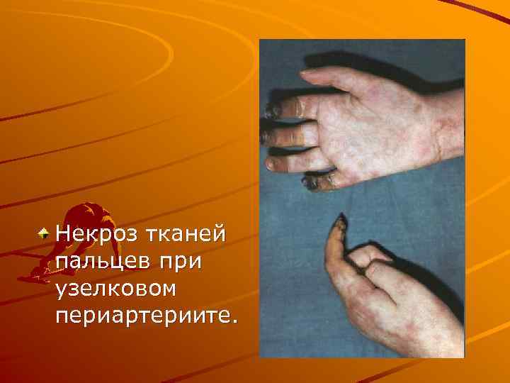 Некроз тканей пальцев при узелковом периартериите. 