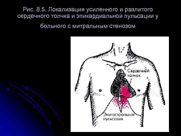 Рис. 8. 5. Локализация усиленного и разлитого сердечного толчка и эпикардиальной пульсации у больного