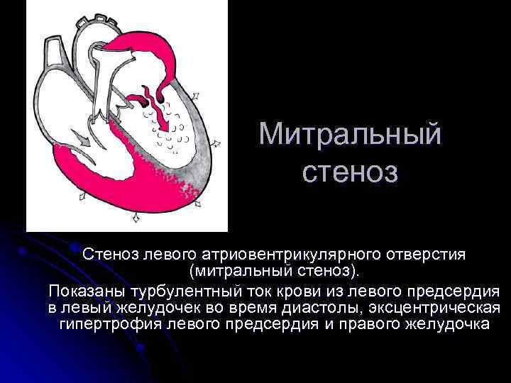 Митральный стеноз Стеноз левого атриовентрикулярного отверстия (митральный стеноз). Показаны турбулентный ток крови из левого