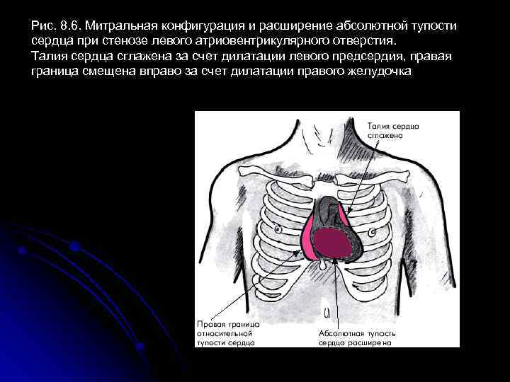 Рис. 8. 6. Митральная конфигурация и расширение абсолютной тупости сердца при стенозе левого атриовентрикулярного