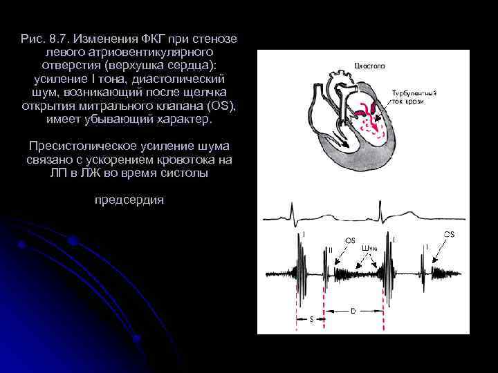 Рис. 8. 7. Изменения ФКГ при стенозе левого атриовентикулярного отверстия (верхушка сердца): усиление I