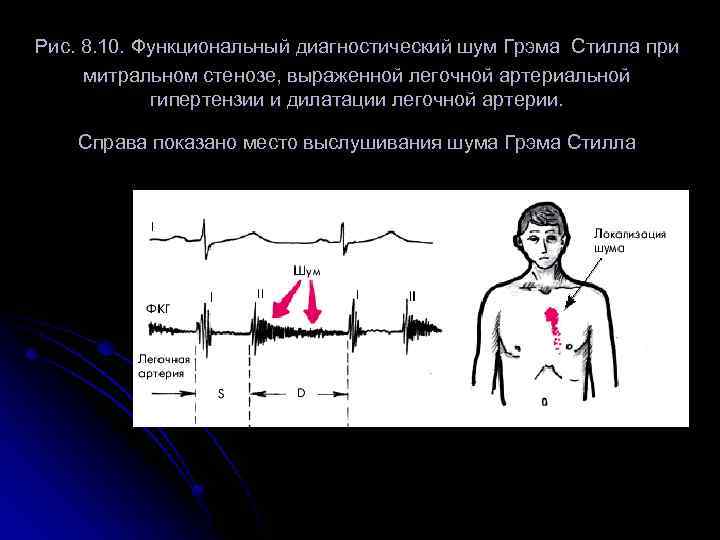  Рис. 8. 10. Функциональный диагностический шум Грэма Стилла при митральном стенозе, выраженной легочной