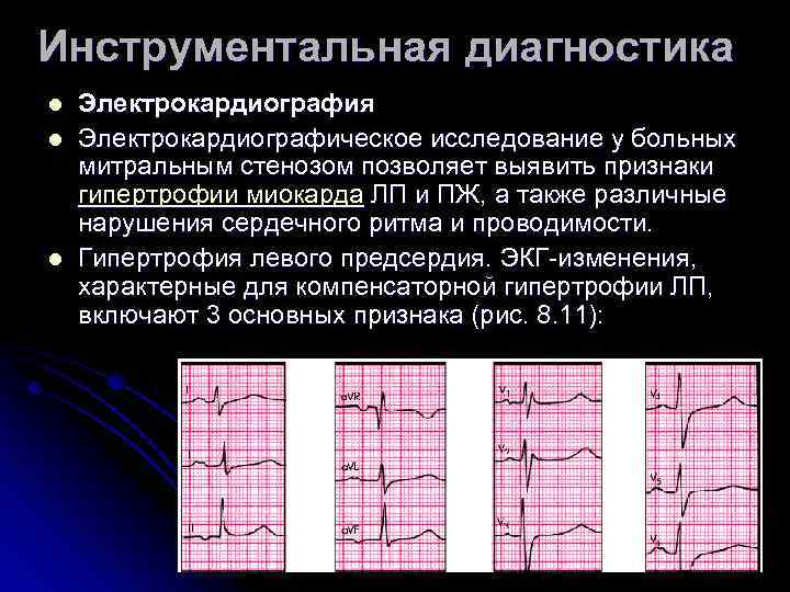 Инструментальная диагностика l l l Электрокардиография Электрокардиографическое исследование у больных митральным стенозом позволяет выявить