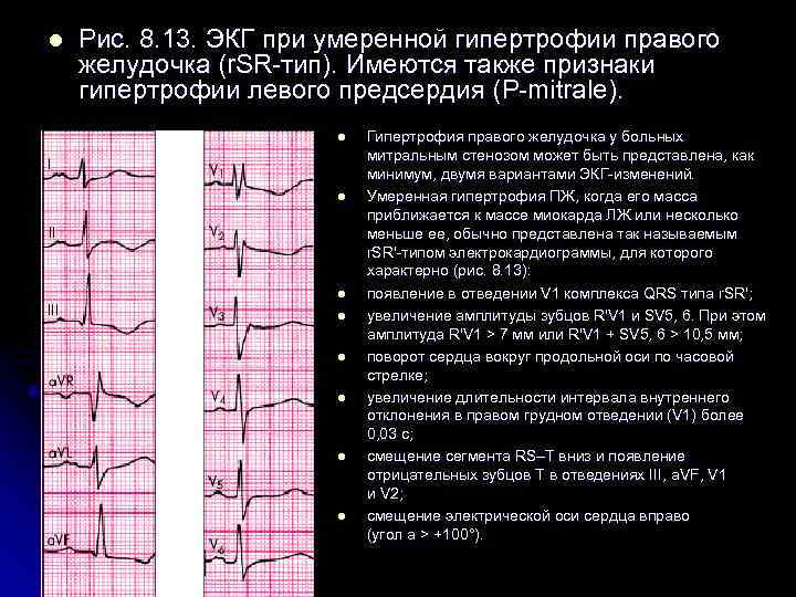 l Рис. 8. 13. ЭКГ при умеренной гипертрофии правого желудочка (r. SR-тип). Имеются также