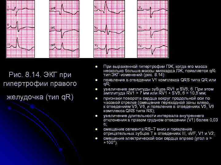 l Рис. 8. 14. ЭКГ при гипертрофии правого желудочка (тип q. R) l l