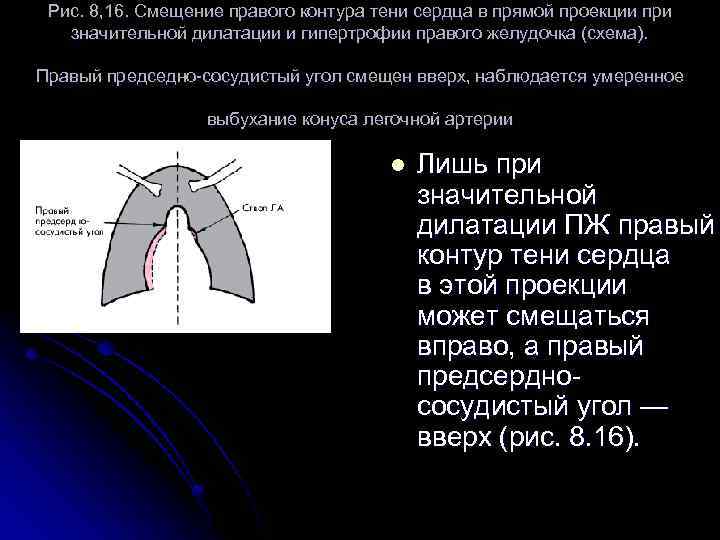 Рис. 8, 16. Смещение правого контура тени сердца в прямой проекции при значительной дилатации