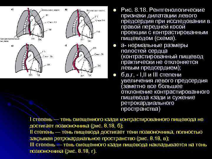 l l l Рис. 8. 18. Рентгенологические признаки дилатации левого предсердия при исследовании в