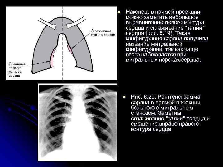 l Наконец, в прямой проекции можно заметить небольшое выравнивание левого контура сердца и сглаживание