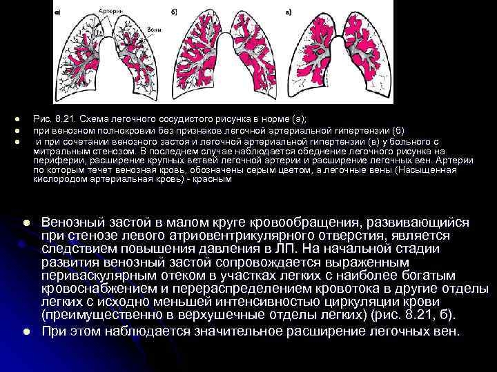 Рис. 8. 21. Схема легочного сосудистого рисунка в норме (а); при венозном полнокровии без