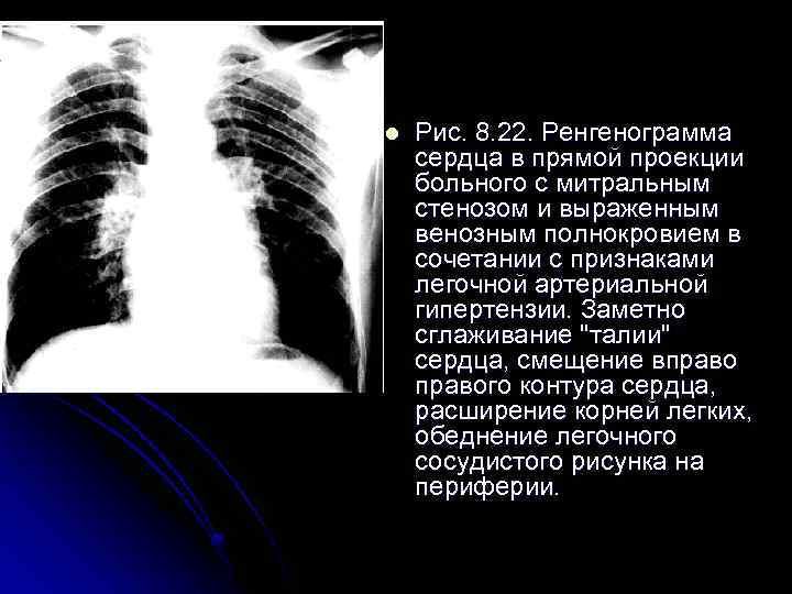 l Рис. 8. 22. Ренгенограмма сердца в прямой проекции больного с митральным стенозом и