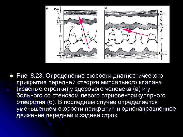 l Рис. 8. 23. Определение скорости диагностического прикрытия передней створки митрального клапана (красные стрелки)