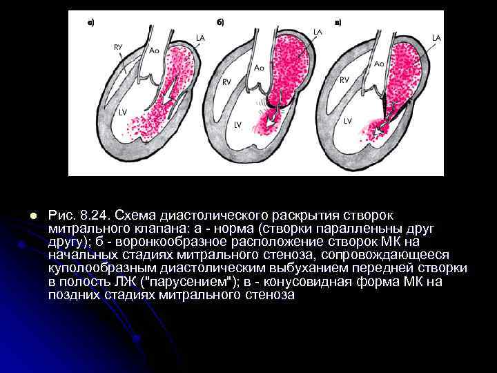 l Рис. 8. 24. Схема диастолического раскрытия створок митрального клапана: а - норма (створки