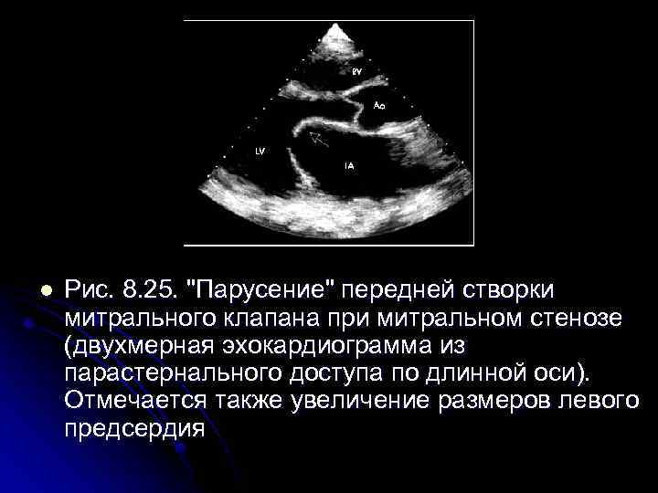 l Рис. 8. 25. "Парусение" передней створки митрального клапана при митральном стенозе (двухмерная эхокардиограмма