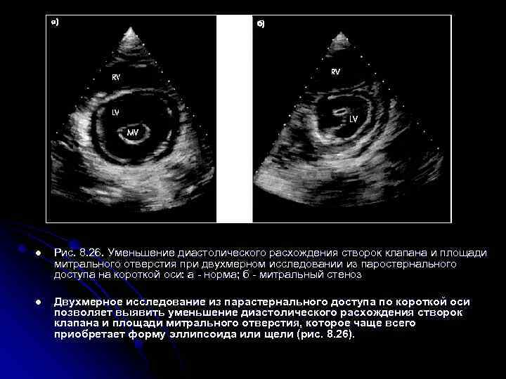 l Рис. 8. 26. Уменьшение диастолического расхождения створок клапана и площади митрального отверстия при