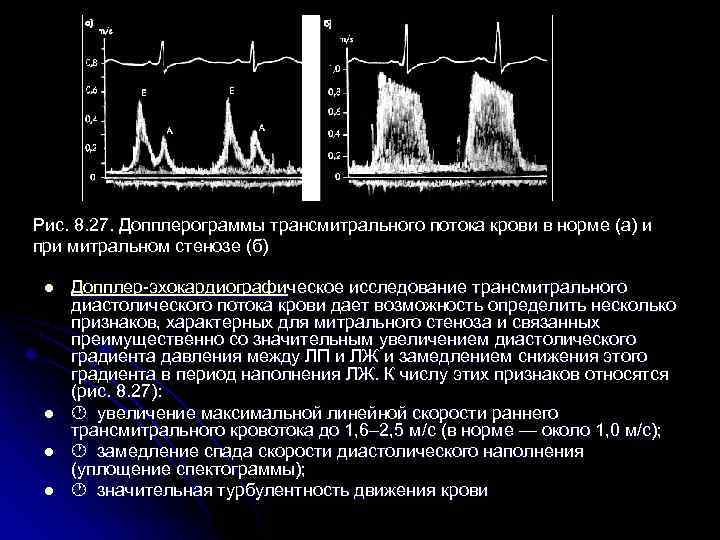 Рис. 8. 27. Допплерограммы трансмитрального потока крови в норме (а) и при митральном стенозе