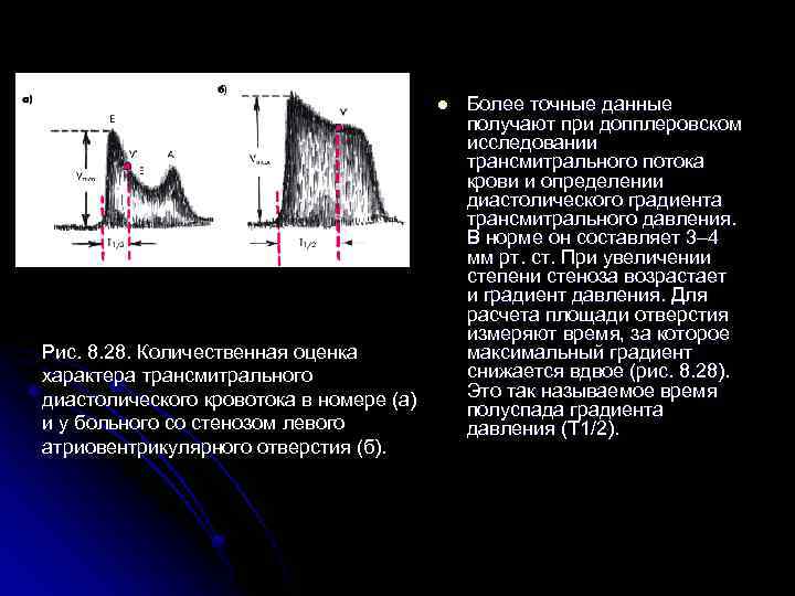 l Рис. 8. 28. Количественная оценка характера трансмитрального диастолического кровотока в номере (а) и