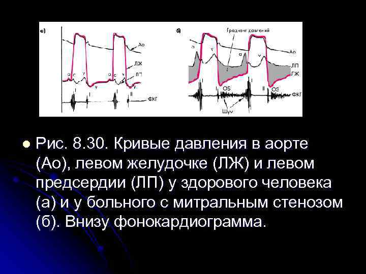 l Рис. 8. 30. Кривые давления в аорте (Ао), левом желудочке (ЛЖ) и левом