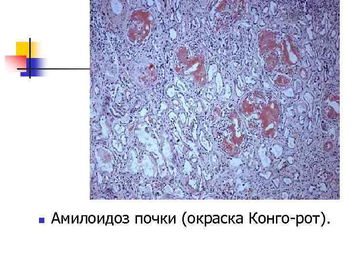 n Амилоидоз почки (окраска Конго-рот). 