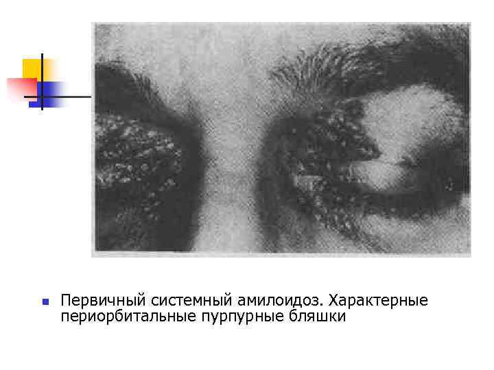 n Первичный системный амилоидоз. Характерные периорбитальные пурпурные бляшки 
