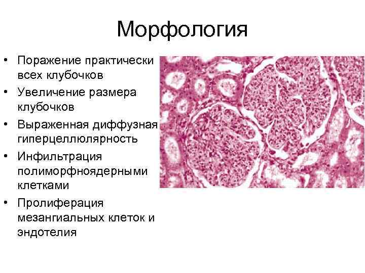 Морфология • Поражение практически всех клубочков • Увеличение размера клубочков • Выраженная диффузная гиперцеллюлярность