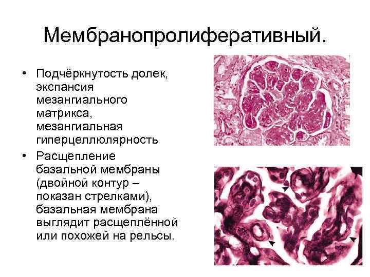 Мембранопролиферативный. • Подчёркнутость долек, экспансия мезангиального матрикса, мезангиальная гиперцеллюлярность • Расщепление базальной мембраны (двойной
