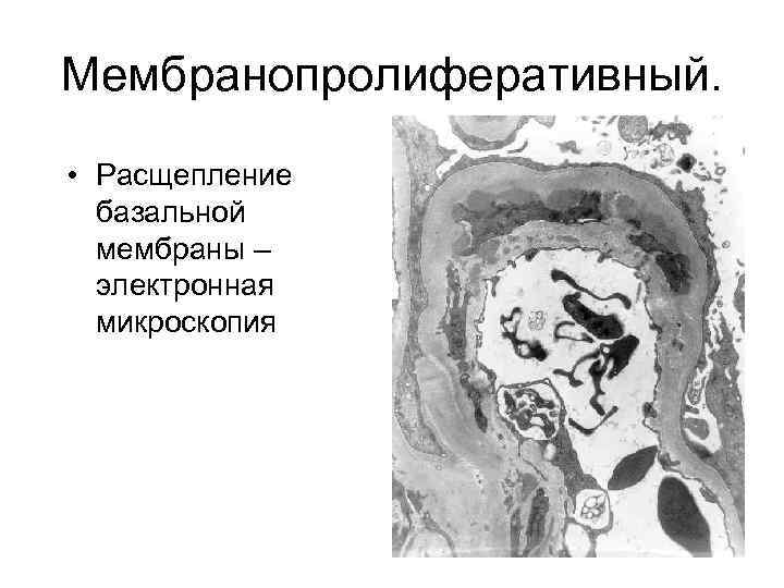 Мембранопролиферативный. • Расщепление базальной мембраны – электронная микроскопия 