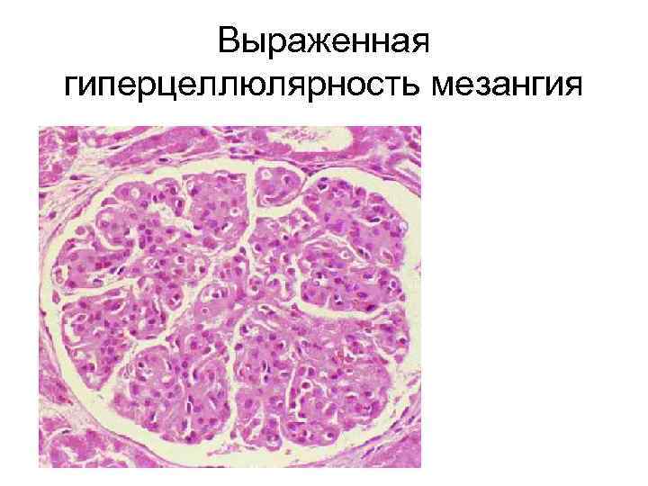 Выраженная гиперцеллюлярность мезангия 