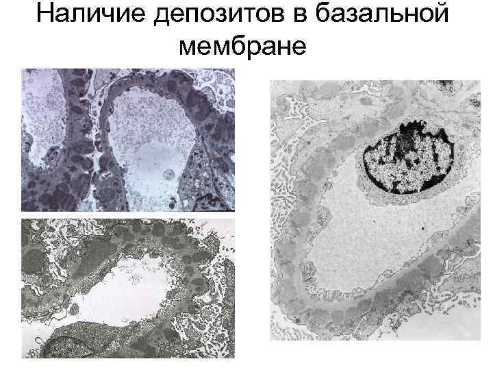 Наличие депозитов в базальной мембране 