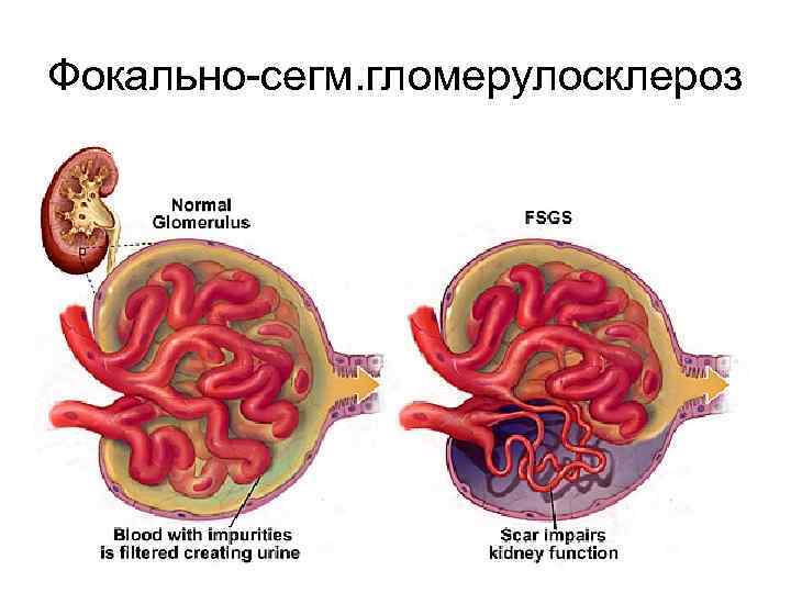 Фокально-сегм. гломерулосклероз 