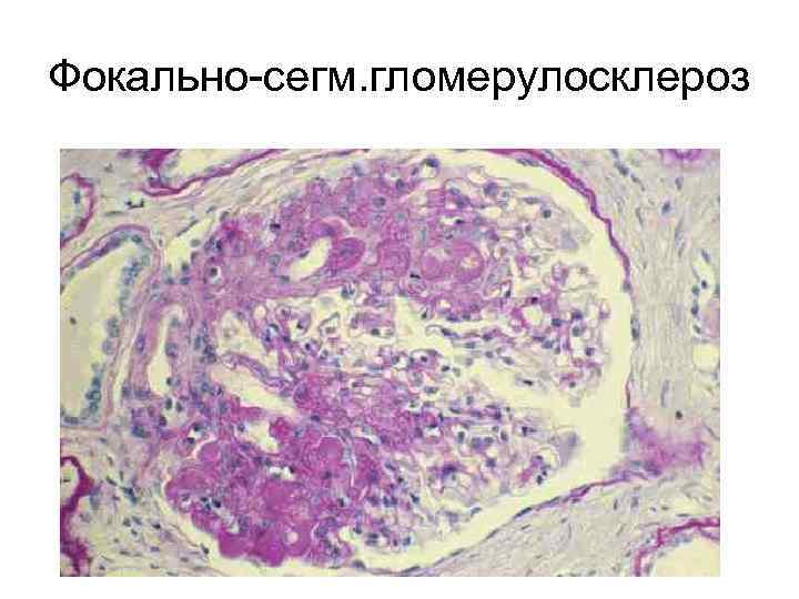 Фокально-сегм. гломерулосклероз 