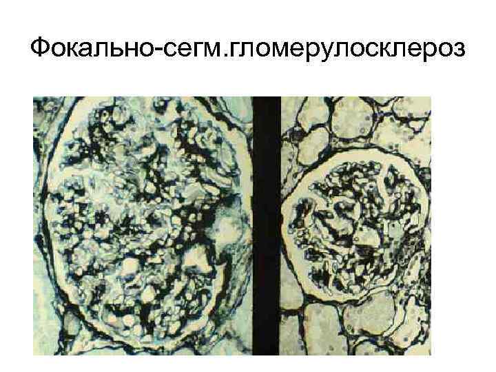 Фокально-сегм. гломерулосклероз 
