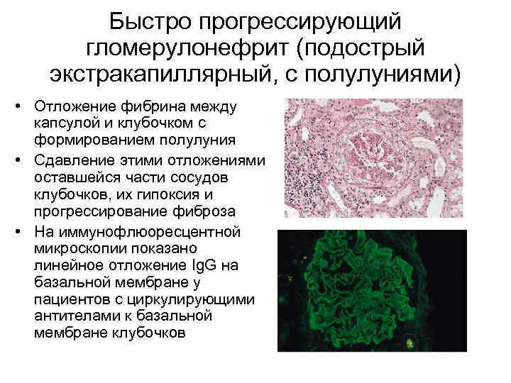 Быстро прогрессирующий гломерулонефрит (подострый экстракапиллярный, с полулуниями) • Отложение фибрина между капсулой и клубочком