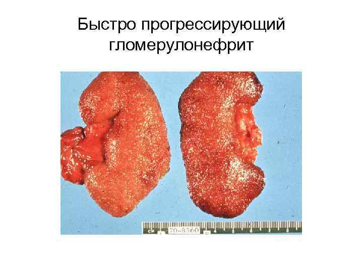 Быстро прогрессирующий гломерулонефрит 
