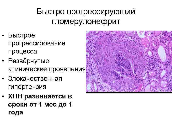 Быстро прогрессирующий гломерулонефрит • Быстрое прогрессирование процесса • Развёрнутые клинические проявления • Злокачественная гипертензия