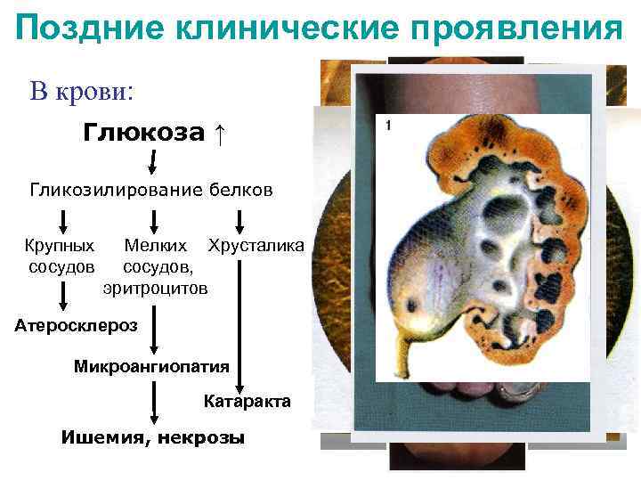 Поздние клинические проявления В крови: Глюкоза ↑ Гликозилирование белков Крупных сосудов Мелких Хрусталика сосудов,