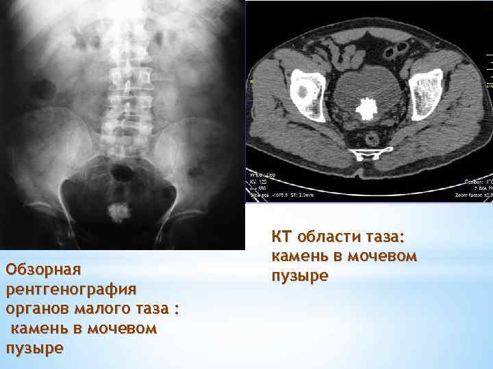 Обзорная рентгенография органов малого таза : камень в мочевом пузыре КТ области таза: камень