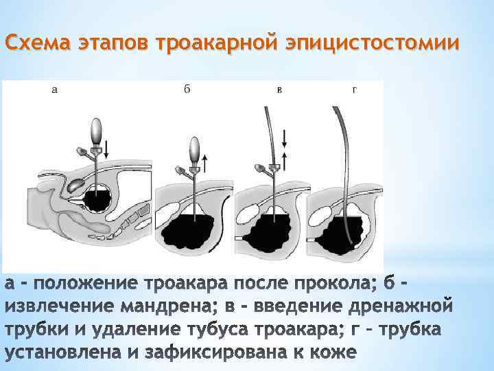 Схема этапов троакарной эпицистостомии 