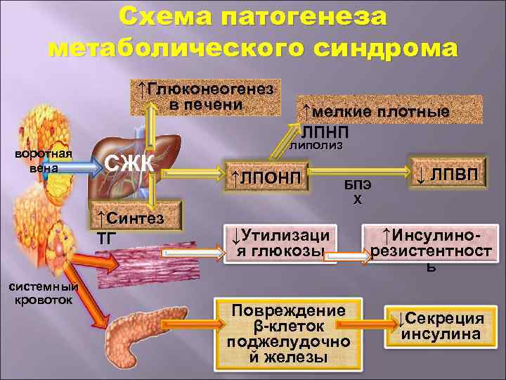 Схема патогенеза метаболического синдрома ↑Глюконеогенез в печени ↑мелкие плотные ЛПНП воротная вена СЖК ↑Синтез