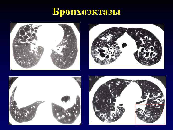 Бронхоэктазы 