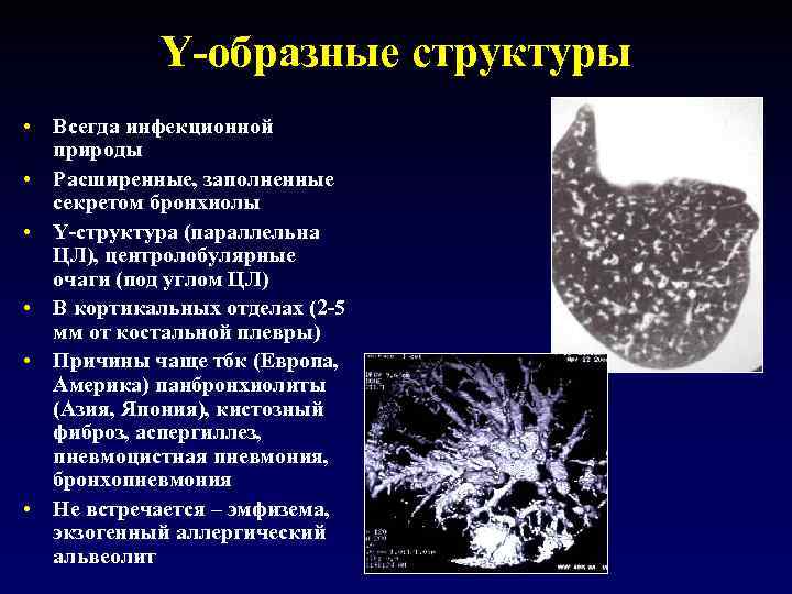 Y-образные структуры • Всегда инфекционной природы • Расширенные, заполненные секретом бронхиолы • Y-структура (параллельна