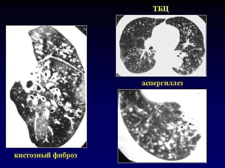 ТБЦ аспергиллез кистозный фиброз 