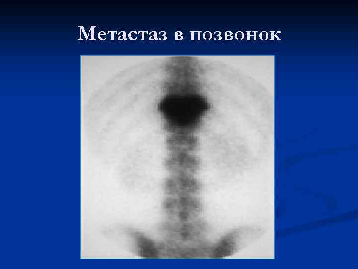 Метастаз в позвонок 