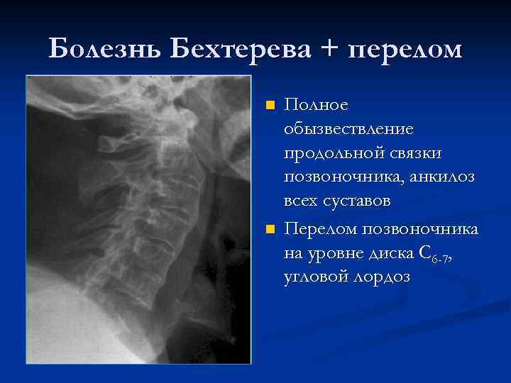 Болезнь Бехтерева + перелом n n Полное обызвествление продольной связки позвоночника, анкилоз всех суставов