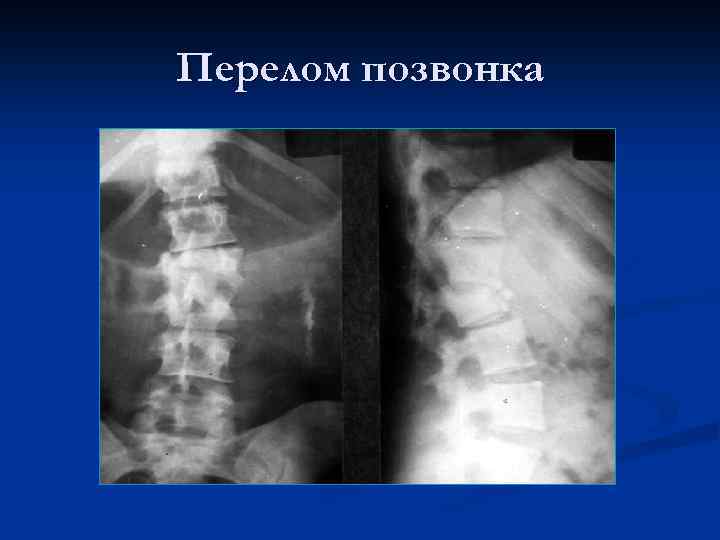 Перелом позвонка 