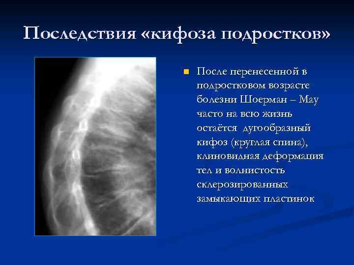 Последствия «кифоза подростков» n После перенесенной в подростковом возрасте болезни Шоерман – Мау часто